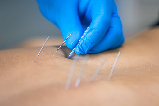 Why Everyone’s Talking About Dry Needling in Stuart, FL (and Whether It’s Right for You)