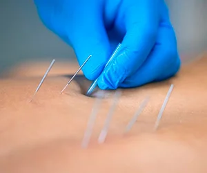 Dry Needling Dry Needling